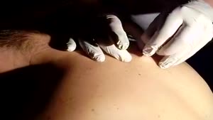 discusting back cyst