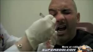 Nasal Tampon Removal