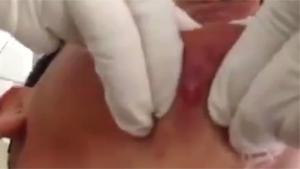 Removing Botfly From Under Skin