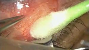 Removing Parasite From Eye