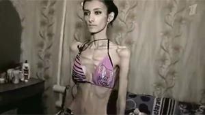 Skinniest Girl In The World