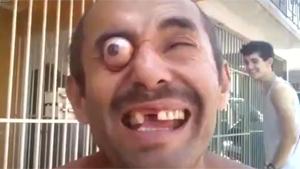 Popping Eyeball