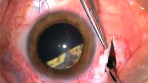 Removing Glass From Eye