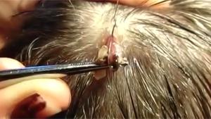 Removing Botfly Maggot From Head