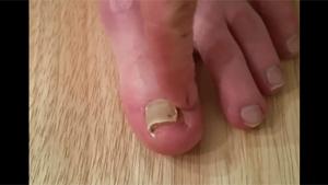 Ripping Off Rotten Toe Nail