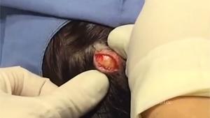 Popping A Cyste