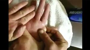 Big Cyst Pops With Surprise