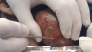 Popping Huge Abces In Throat