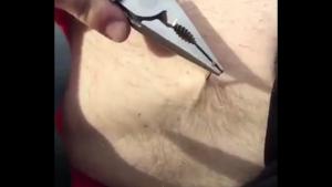 Removing Huge Splinter