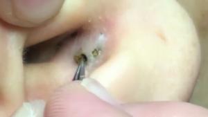 Removing Nasty Black Head From Ear
