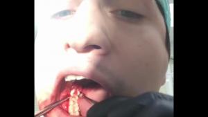 Dentist Pulls Out His Own Tooth