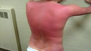 Burned back gets slapped